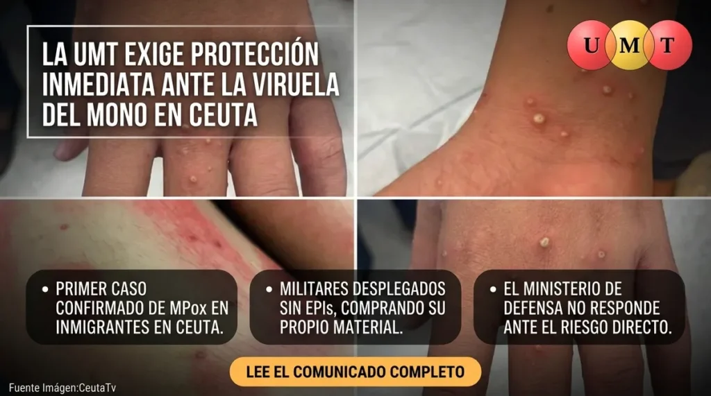 La UMT exige protección inmediata ante el primer caso confirmado de Viruela del Mono en Ceuta