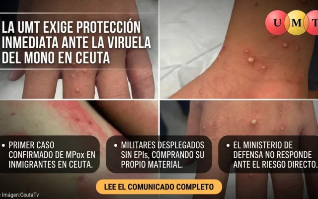 La UMT exige protección inmediata ante el primer caso confirmado de Viruela del Mono en Ceuta